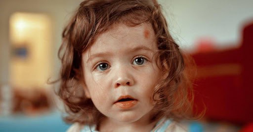 young girl has a red mark on her forehead Helland & Hurwitz Attorneys at Law Colorado